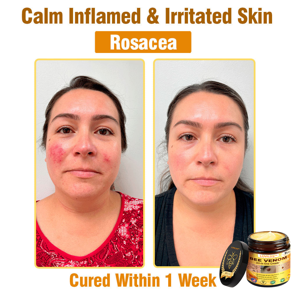 𝐋𝐎𝐕𝐈𝐋𝐃𝐒™ 𝐁𝐞𝐞 𝐕𝐞𝐧𝐨𝐦 𝐀𝐥𝐥-𝐢𝐧-𝐎𝐧𝐞 𝐂𝐫𝐞𝐚𝐦–🌸 Anti-aging,Hydrating, Skin Repair, Even Tone, Acne and Dark Spot Treatment, Wart and Mole Removal, Psoriasis Relief